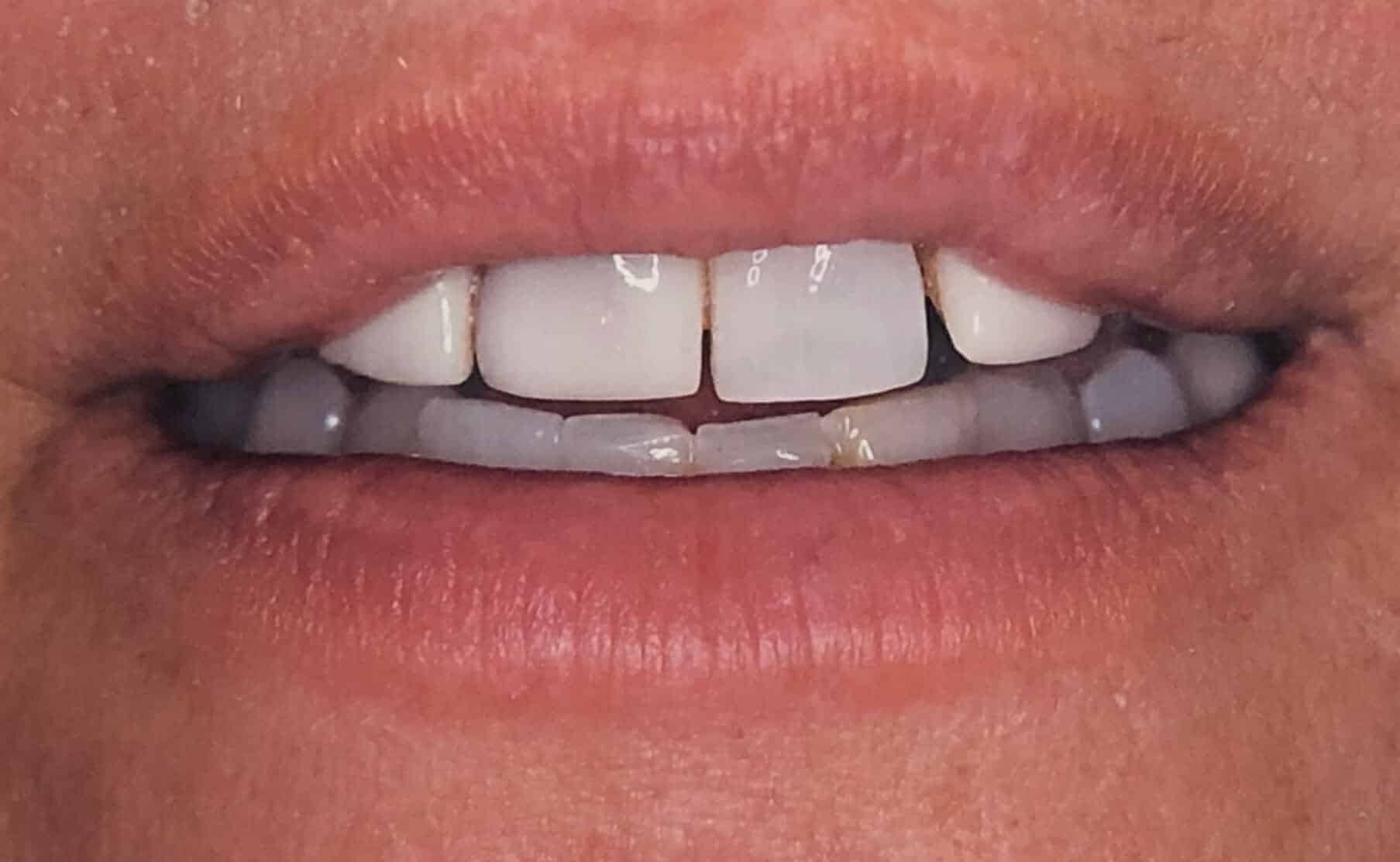 Dentures in Chicago, IL