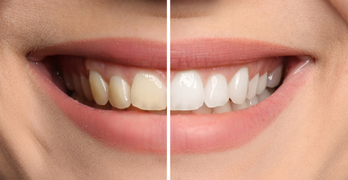 Before and After of teeth whitening by Dr. Paul Anast