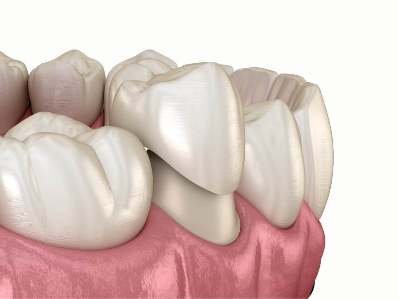 Example of how a dental crown fits over the damaged tooth